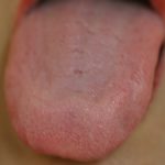 基礎の舌診断法 厚さと舌質